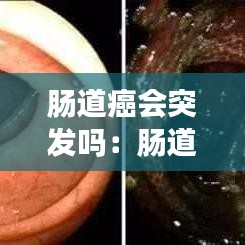 腸道癌會(huì)突發(fā)嗎：腸道癌會(huì)怎么樣 