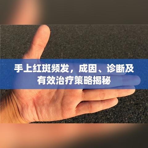 手上紅斑頻發(fā)，成因、診斷及有效治療策略揭秘